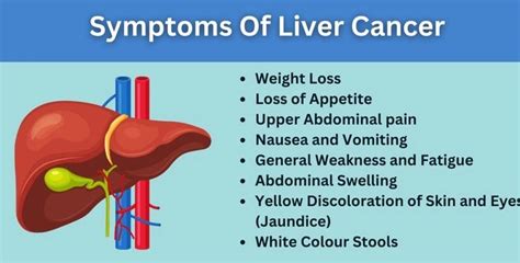 liver cancer near rocklin|Liver Cancer: Signs, Symptoms, and Complications.